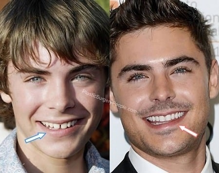 A before (left) and after (right) of Zac Efron showing his changing teeth.